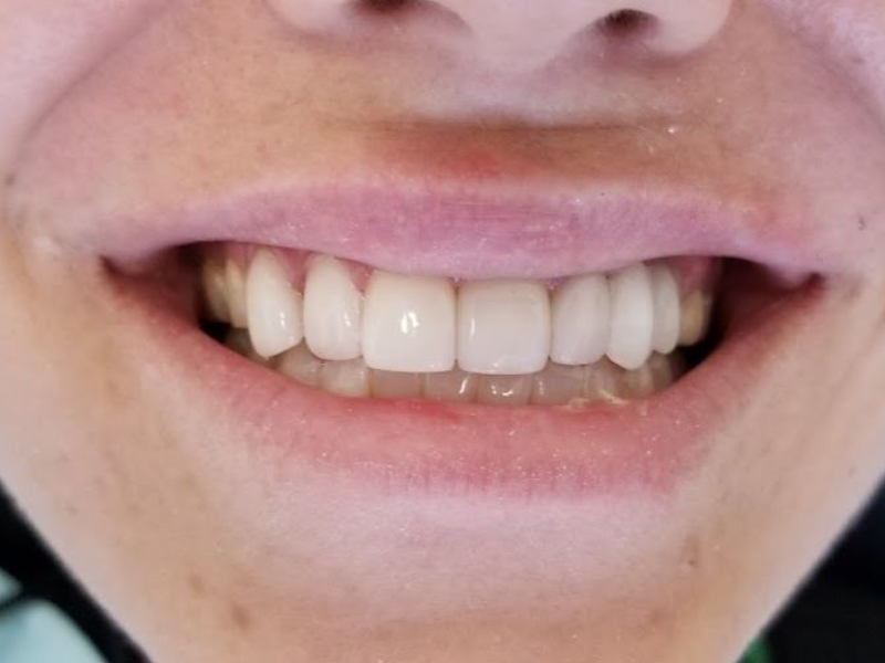 Dental Implant After