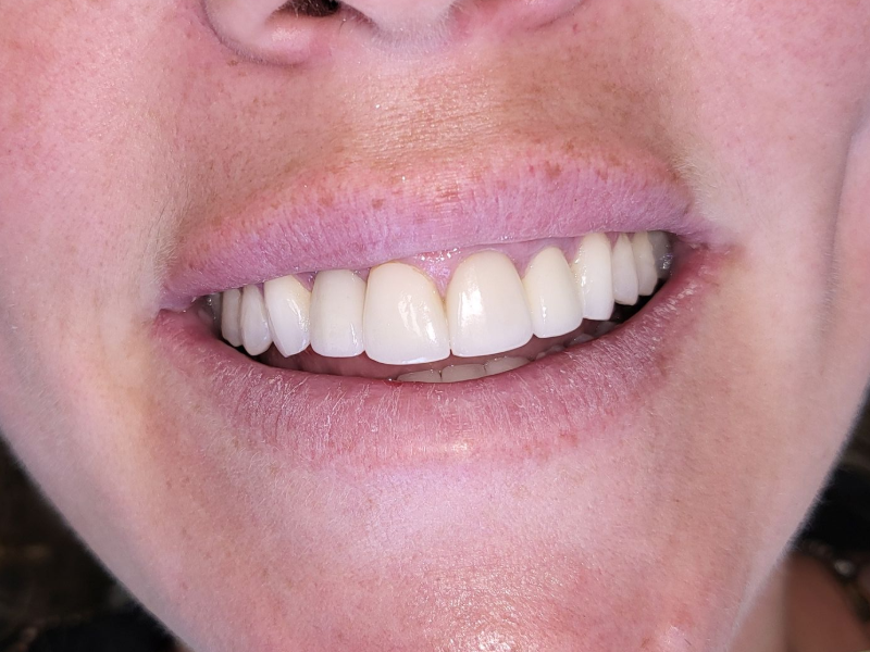 Dental Implant After