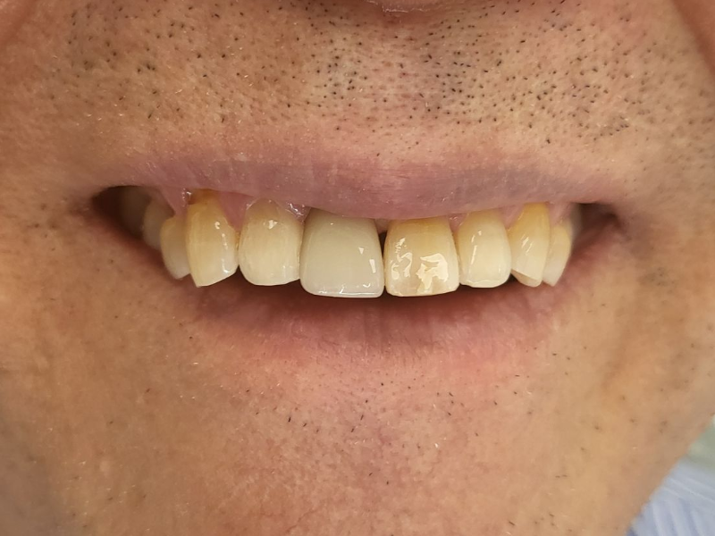 Dental Implant After