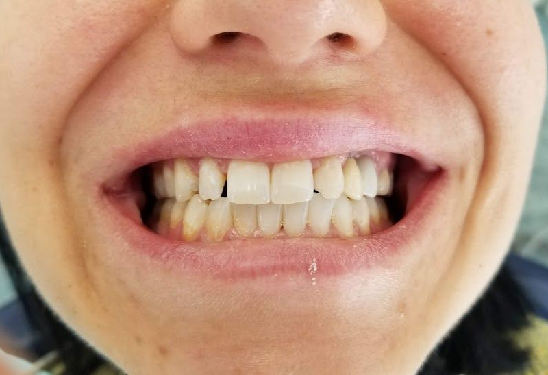 Dental Implant Before