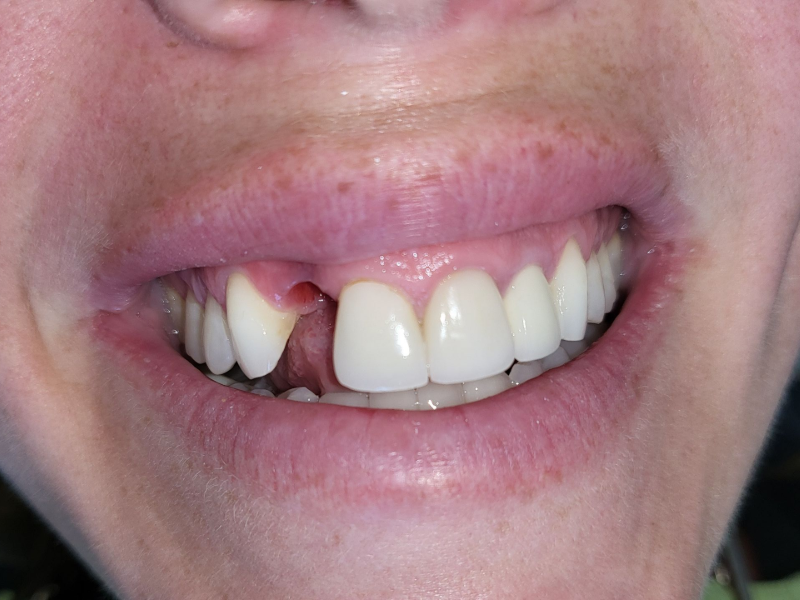 Dental Implant Before
