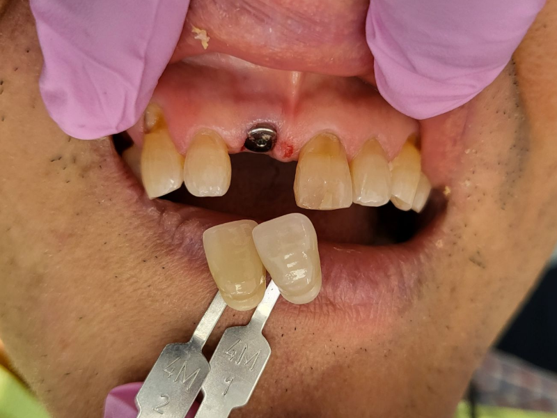 Dental Implant Before