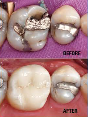 decayed teeth — cerec dentistry in Yorktown Heights, NY