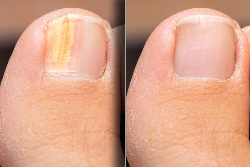 Visual transformation after effective treatment for toes — Dynamic Stride Podiatry in Maitland, NSW