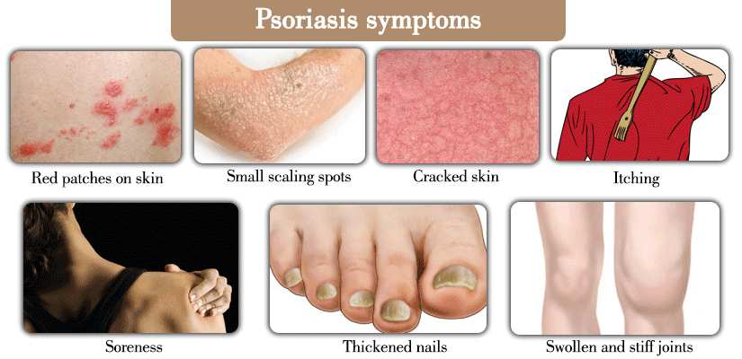 Discussion On Psoriasis Part 1