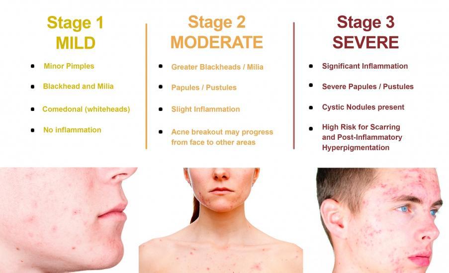 Acne Treatment Available In The Pine Belt