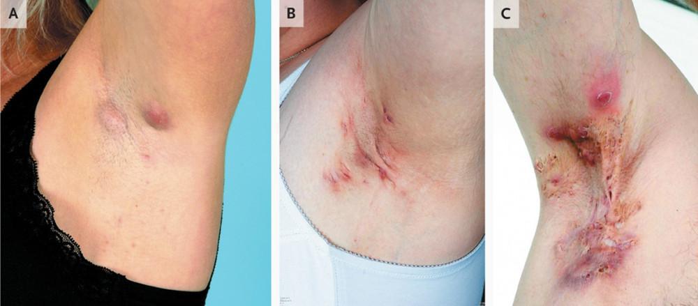 Know The Facts About Hidradenitis Suppurativa a k a HS 