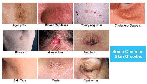 genital skin tags vs warts