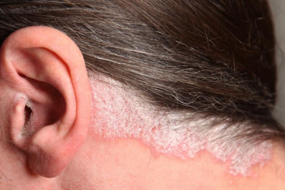 Scalp Psoriasis Treatment At Pine Belt Dermatology & Skin Cancer Center