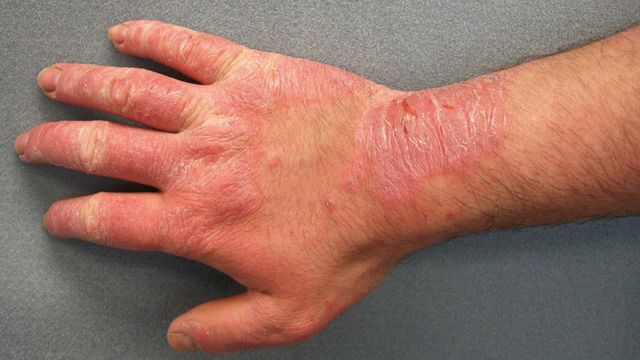 Hand Rashes: Causes, Tips, Prevention, & Treatment