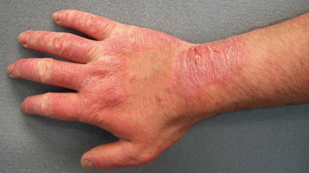hives on hands
