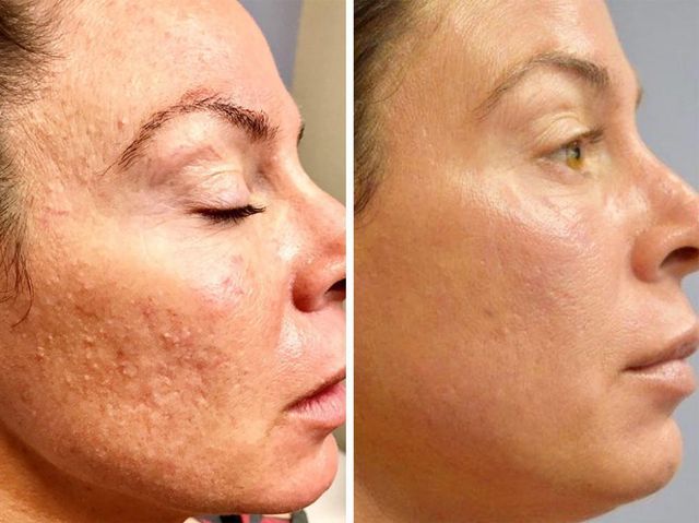 Skin Rejuvenation