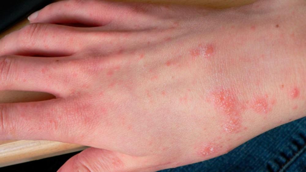 Scabies – The Infuriating & Insatiable Itch