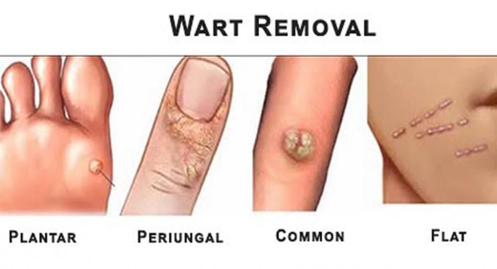 papillomavirus types of warts)