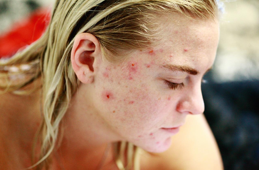 Acne for adults | Pine Belt Dermatology