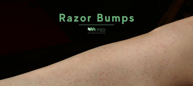 What Are Razor Bumps & How to Treat Them | Pinebelt Derm, MS