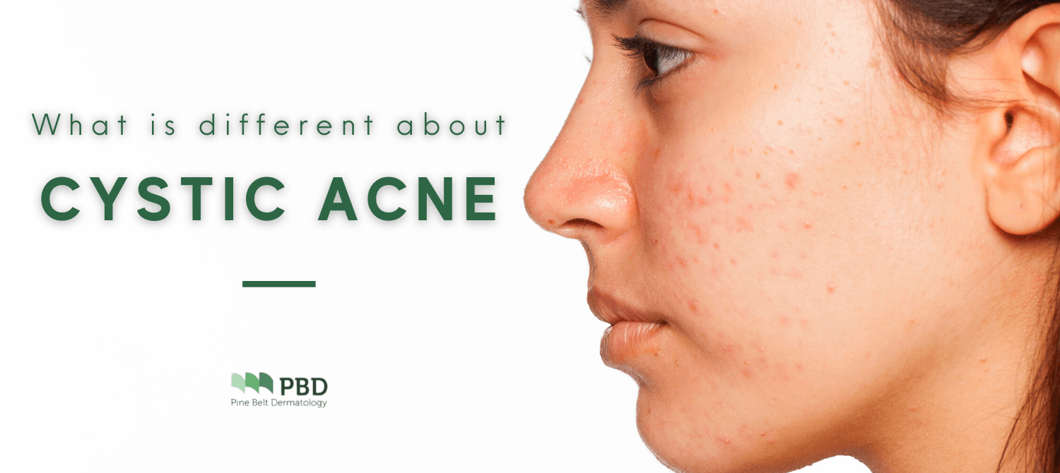 Woman with cystic acne