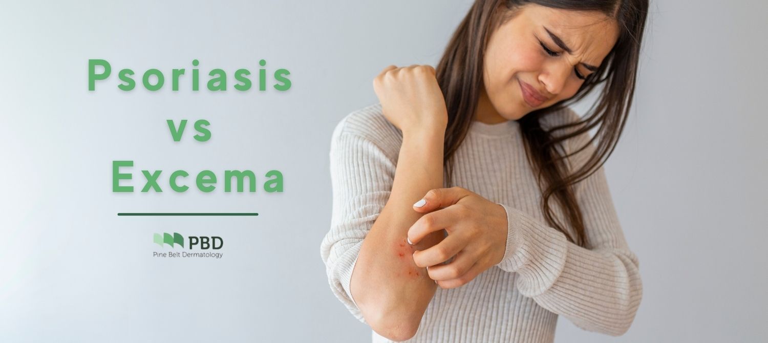 The Difference Between Psoriasis & Eczema | Pine Belt Dermatology