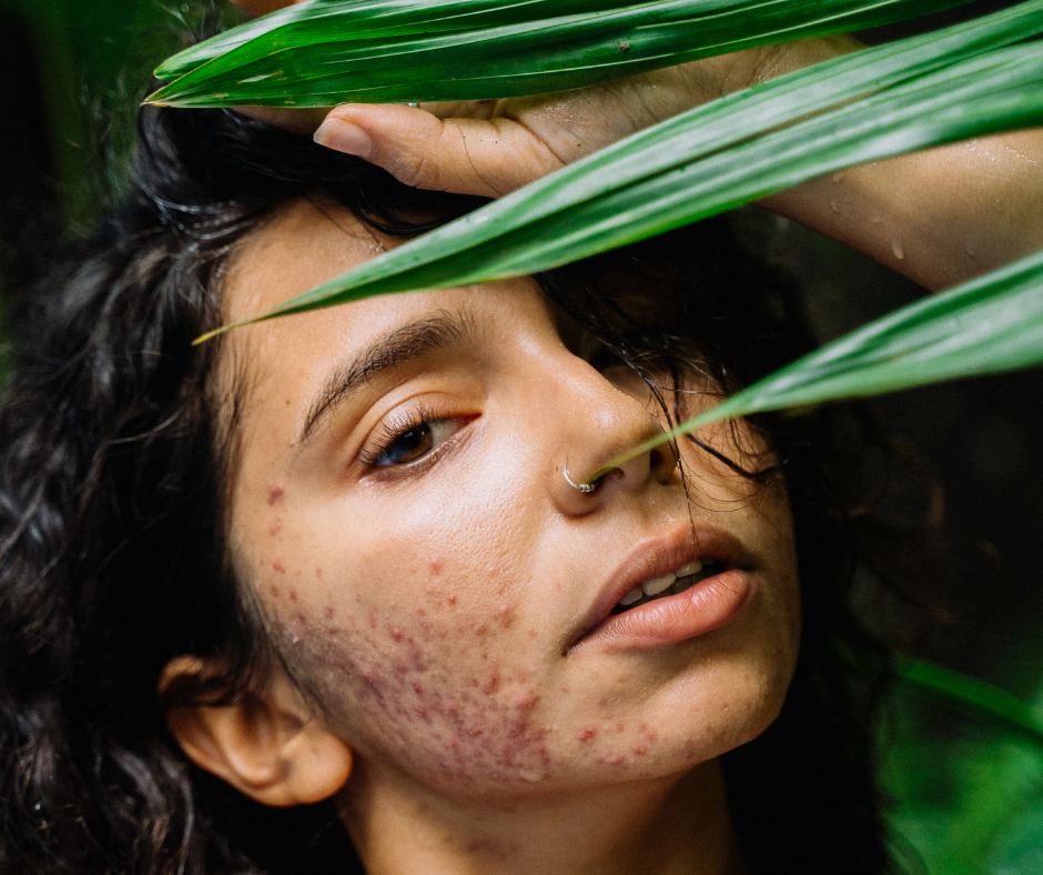 How to Prevent Summer Breakouts and Oily Skin | Pine Belt Dermatology