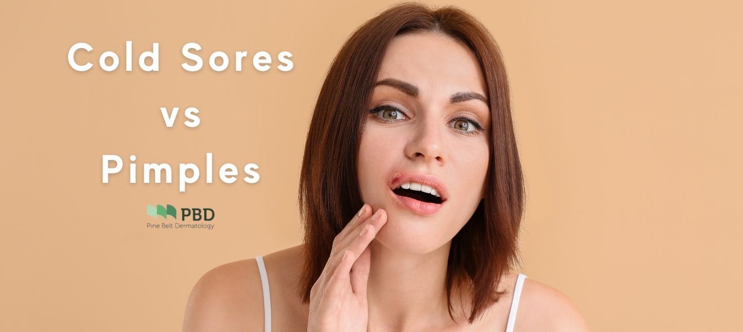 Cold Sores vs. Pimples: What's the Difference?