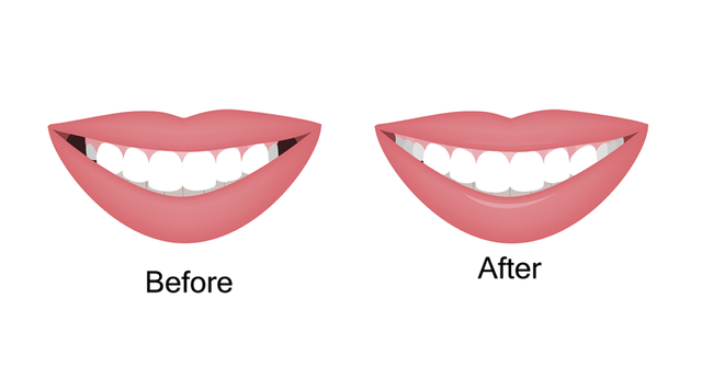 Why use a palatal expander in orthodontics? - Bauer Smiles