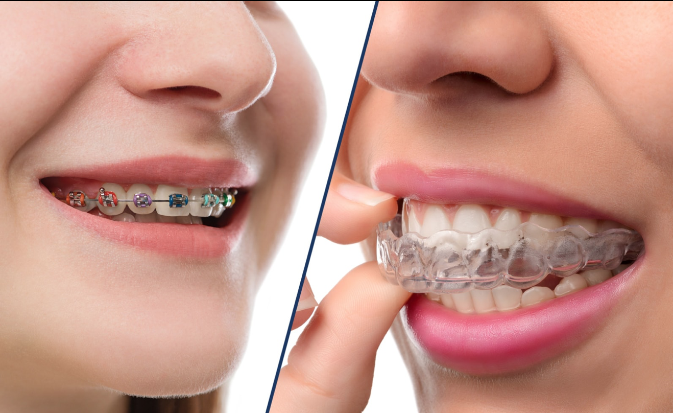 lentes de contato dental tratamento etético odontológico para dentes, odontologia estética em fortaleza ceara