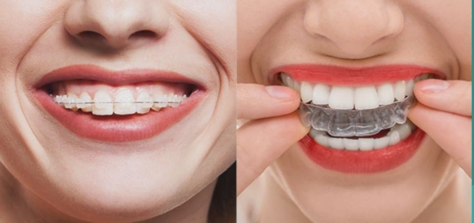 Avaliação comparativa do alinhador dentário transparente versus