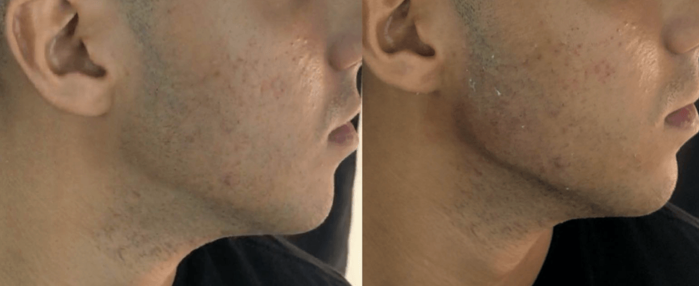 Preenchimento Mandibular Masculino com Antes e Depois