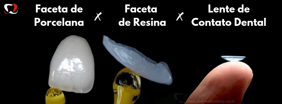 Faceta de Resina, Faceta de Porcelana, Lentes de contato dentais, quais ...