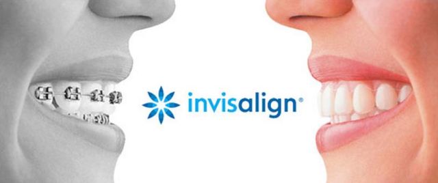 O Invisalign – aparelho invisível – funciona mesmo?