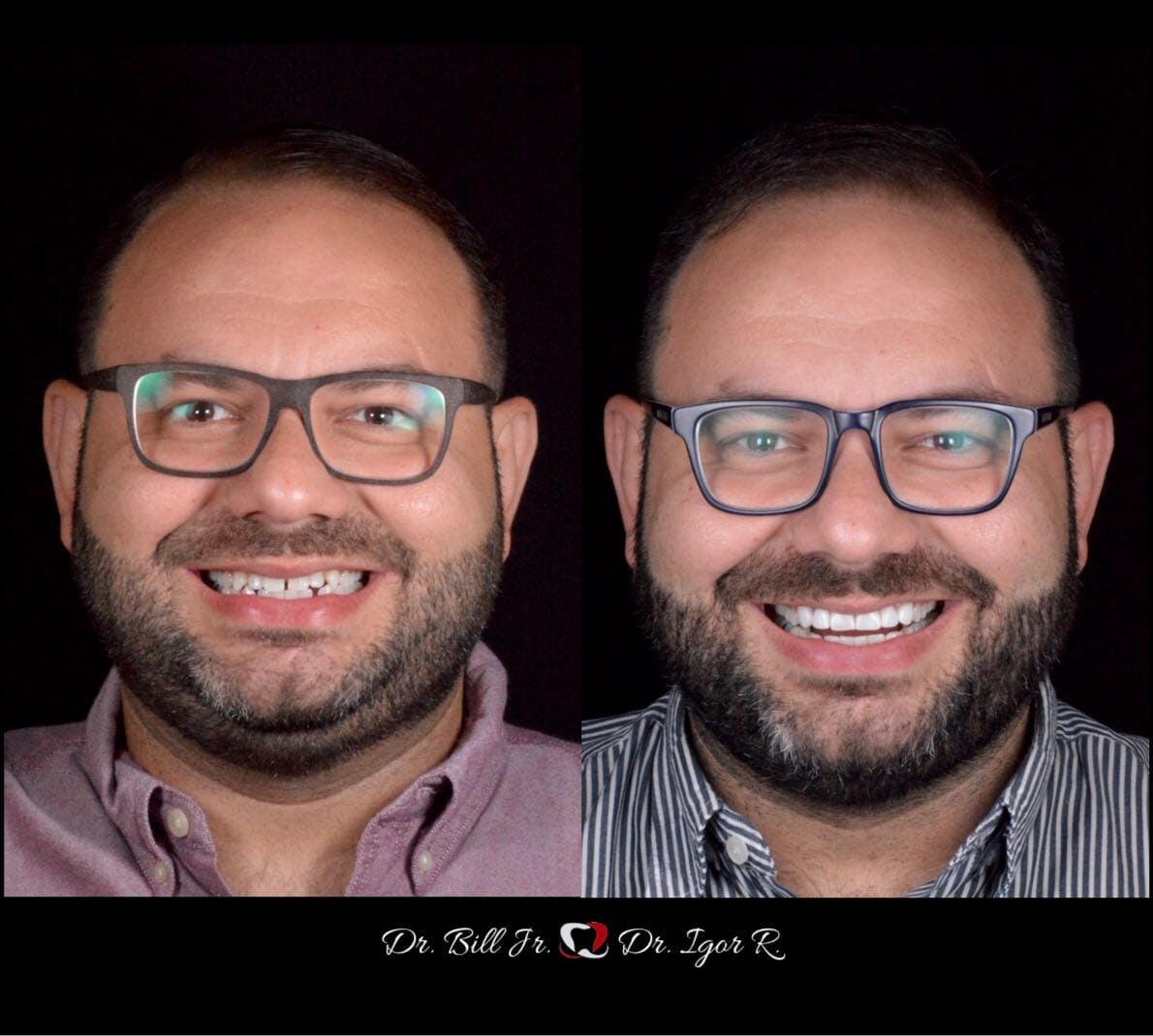 paciente dentes antes e depois lentes de contato dental fortaleza