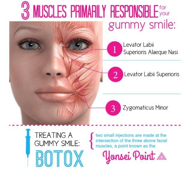 tratamento de sorriso gengival através de Botox (Toxina Botulínica) para  diminuir a força da musculatura e amenizar o sorriso gengival, essa técnica é usada em conjunto com Gengivoplastia ou Gengivectomia