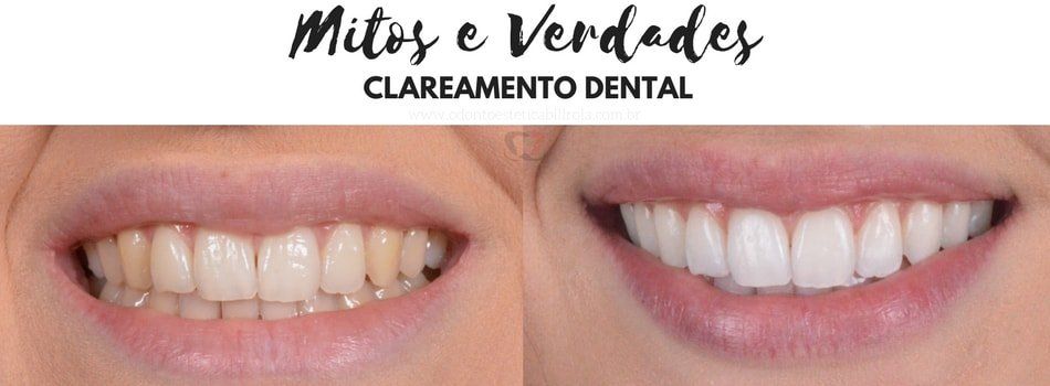 clareamento dental antes e depois  - dentista em fortaleza - claramente dentário em fortaleza
