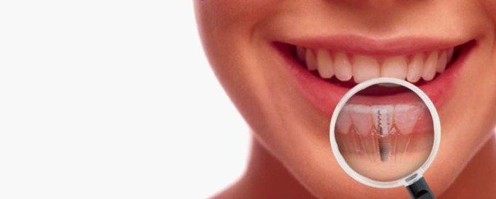 lentes de contato dental tratamento etético odontológico para dentes, odontologia estética em fortaleza ceara