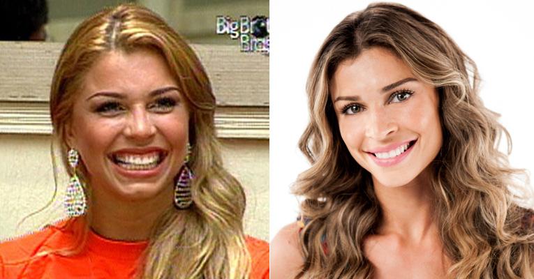 Sorriso gengival antes e depois , remoção através de gengivoplastia