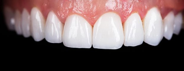 Close-up of a person's bright white, healthy teeth against a black background.