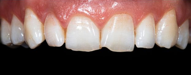 Close-up of a person's upper teeth. The teeth are white with a black background, the gums are pink.