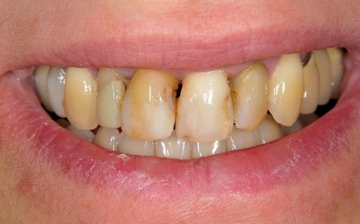Close-up of person's smile, showing teeth with discoloration and some damage.