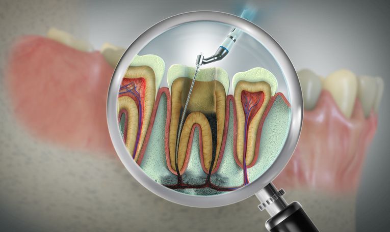 Cross-section of teeth, magnified, showing root canal procedure in progress.