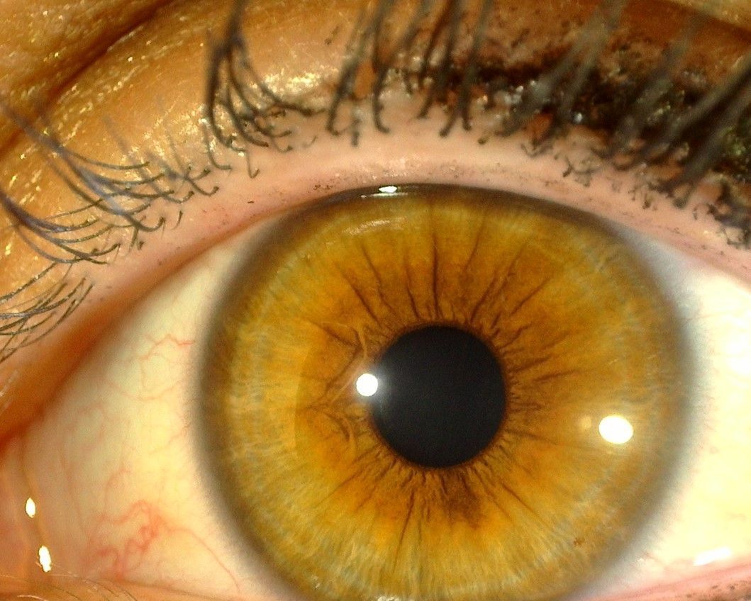 Patientin  33 Jahre alt   /  linke Iris
Beschwerden:   Kopfschmerzen, starke Müdigkeit, Darmkrämpfe und Unterleibskrämpfe, 
Braune Iris:  hämatogene Grundkonstitution, Anlage zu Stoffwechselkrankheiten
Lanzettartige Furchen (Solarstrahlen) von der Pupille nach außen:
nervöser Reizdarm 
rasche Ermüdung und Kopfschmerzen
Helle Ringe am Rand der Iris:   Krämpfe im Darm, Krämpfe an der Gebärmutter
Torbogen, seilartig frei schwebend:   Disposition zu Diabetes 