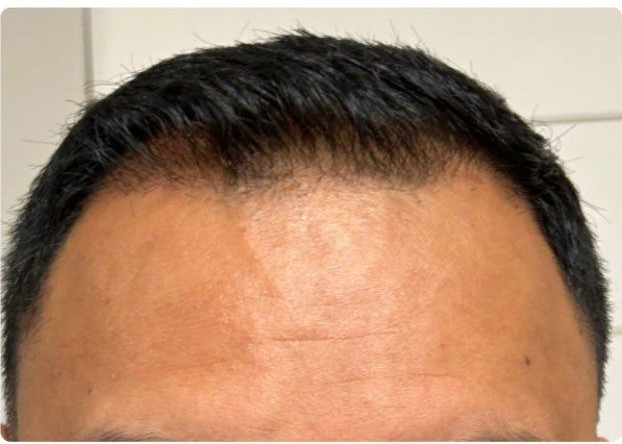 Close-up of a person's forehead and hairline, showing thick, dark, short-cropped hair against a light background.