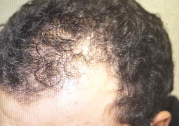 Before and after images of a person's scalp with visible hair loss, then fuller, thicker hair.