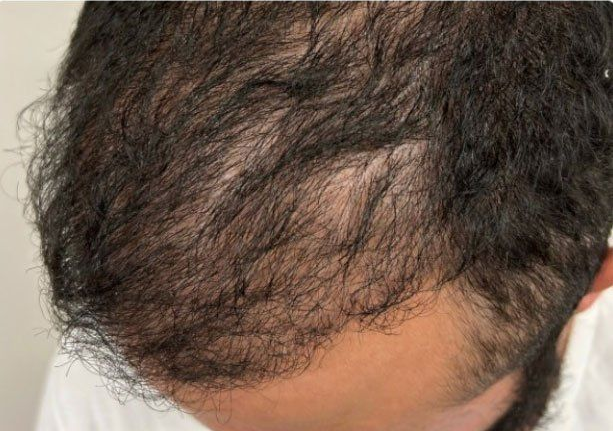 Top-down view showing thinning hair and visible scalp on the crown of a head.