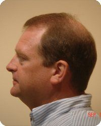 Man with receding hairline, in profile, wearing a striped shirt.