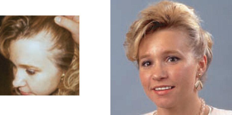 Comparison of a person's hairline showing thinning hair on the left and fuller hair on the right.