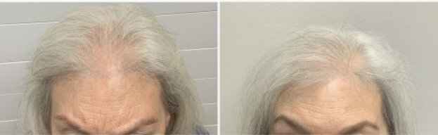 A split-screen comparison showing hair thinning on the scalp before and after treatment.