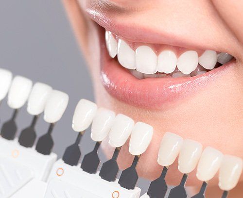 dental veneers Sunland dental
