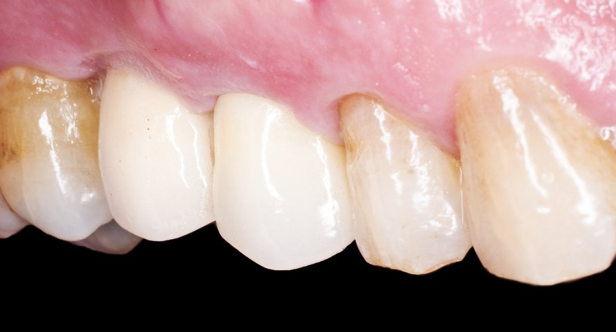 dental crown after