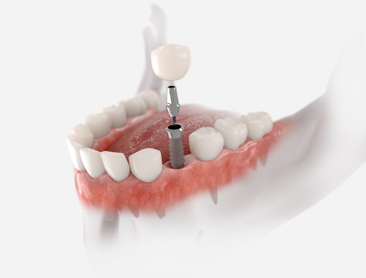dental implant sculpture