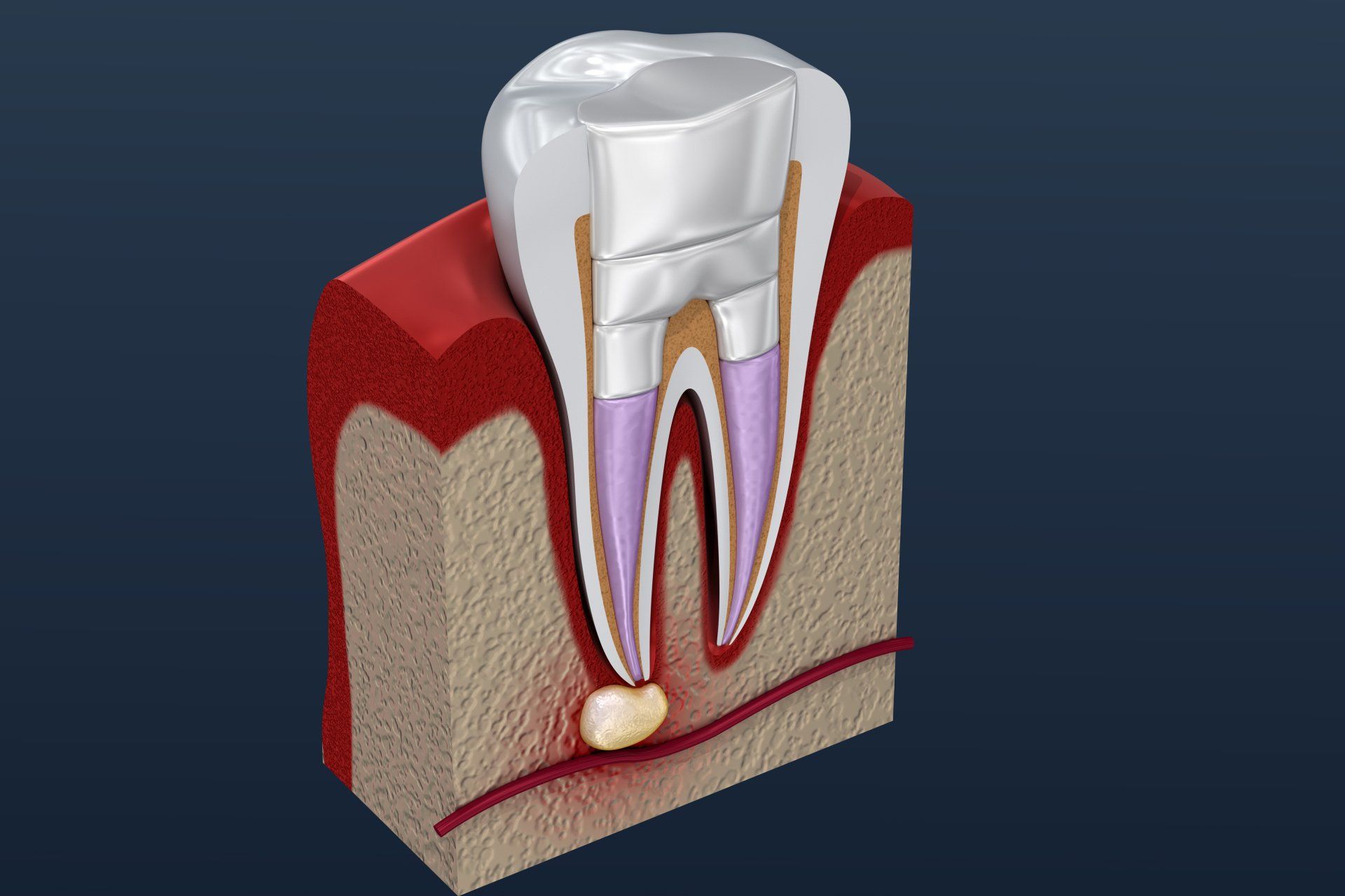 root canal sculpture